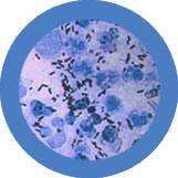 Clap - Gonorrhea (Neisseria Gonorrhoeae) picture
