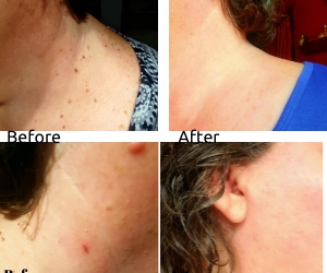 Skin Tag, Wart, Mole Remover Kit