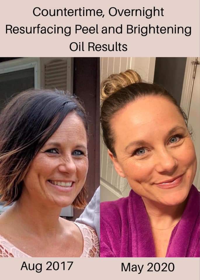 Overnight Resurfacing Peel picture