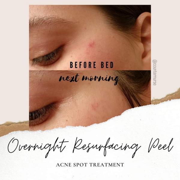 Overnight Resurfacing Peel picture